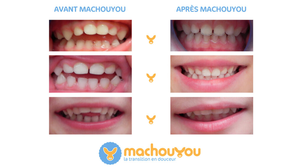 Résultats avant et après l'utilisation du machouYou