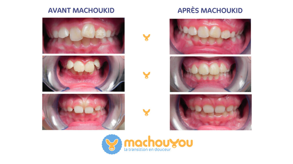 Résultats avant et après l'utilisation du machouKid