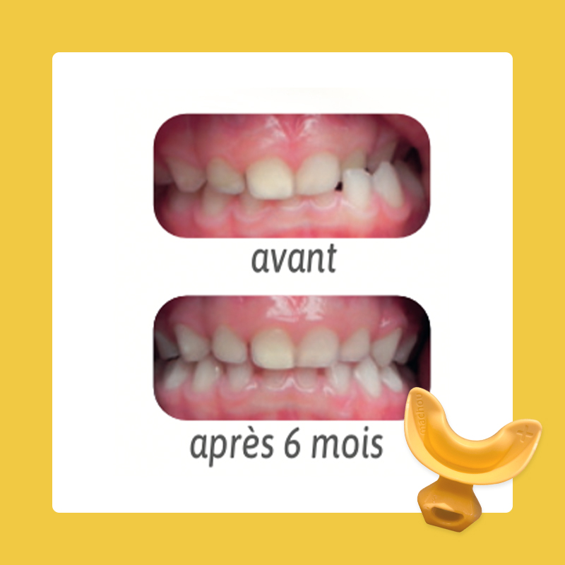 Résultats machou+ en 6 mois alignement dentaire et équilibre de la mâchoire de l'enfant de 2 à 6 ans